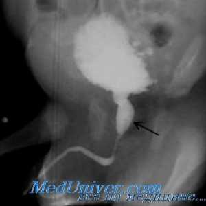 Obstrucție a gâtului vezicii urinare la copii. Supape uretră