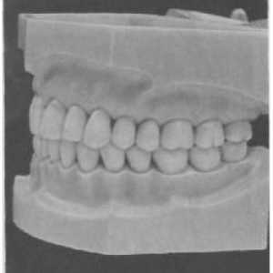 Evaluarea ocluzale și relații articulând dentitie
