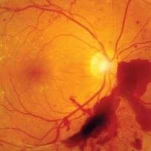 Ocluzia arterei centrale a retinei: tratament, cauze, diagnostic