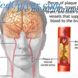 Microcirculația a creierului. Cauzele de accident vascular cerebral