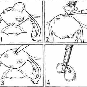 Chirurgie pe uter. miomectomie laparoscopică