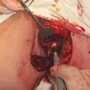 Chirurgie pentru a elimina hemoroizi si fisuri anale