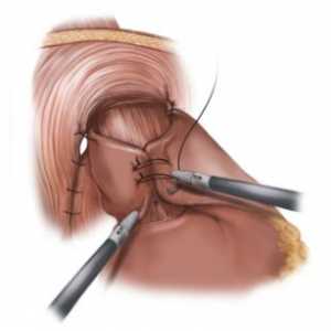 Tratamentul chirurgical al esofagita de reflux si fundoplication