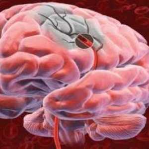 Tumoare pe creier si membranele sale, ceea ce duce la înfrângerea căii vizuale