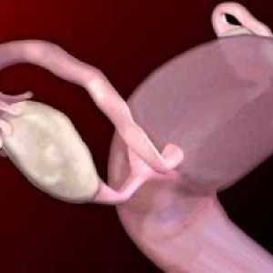 Tumori ovariene la femei benigne și maligne: simptome, tratament, simptome, cauze