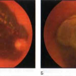 Tumorile retinei si coroida: melanomul coroidiene