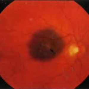 Tumorile retinei si coroida: nev coroidiene