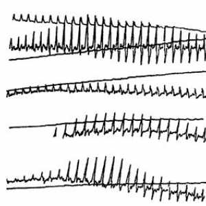 Osciloscop, Capillaroscopic și parametrii pacienților cu sechele ale leziunilor perie înainte și…