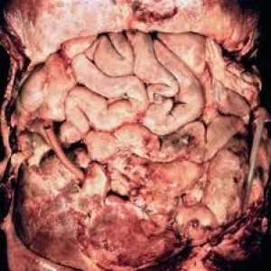 Complicatii ale necrozei pancreatice
