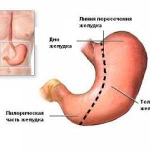 Complicațiile de rezecție gastrică și gastrectomie