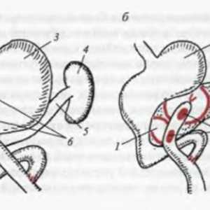 Caracteristici ale tratamentului chirurgical al chisturilor istmului și corpul pancreasului.…