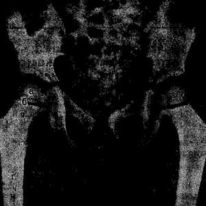 Osteoliza eroziunii osoase