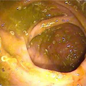 Oxiuri în intestin, anus, anus enterobioză intestinale
