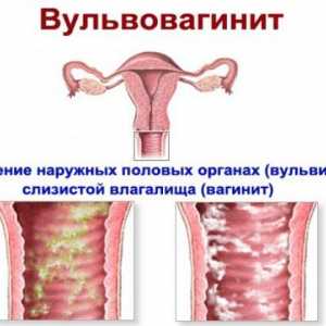 Oxiuri în vagin, organele genitale, uter, enterobioză vaginale