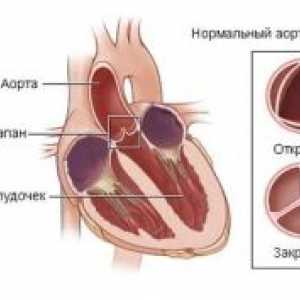 Disfuncție acută a valvelor inimii