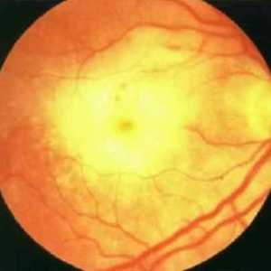 Necroza retiniană acută: simptome, tratament, cauze, simptome