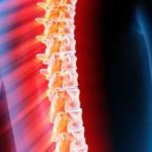 Mielita acută transversal, măduva spinării: tratament, prognostic