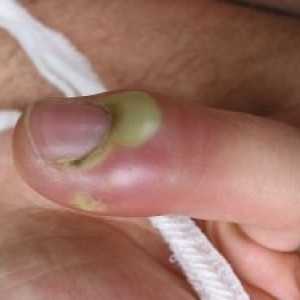 Paronychia: tratament, simptome