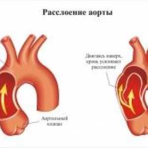 Patologie aortică în timpul sarcinii