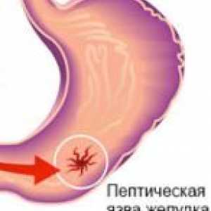 Ulcer peptic: simptomele si tratamentul acesteia