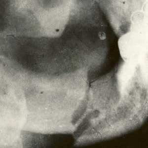 Fracturi de mandibulă