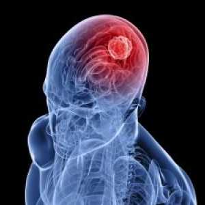 Tumorile cerebrale primare: simptome, tratament, cauze, simptome