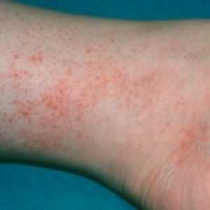 Rocky Mountain spotted febra: Simptome, agent patogen