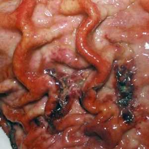 Cancer cu celule scuamoase al stomacului