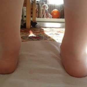 Ploskovalgusnaya picior la copii, tratament