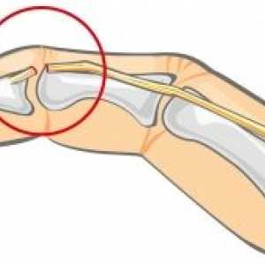 Rupturile subcutanate ale tendoanelor flexoare