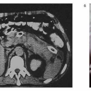Helminților pancreas înfrângere: Clonorchiasis, fascioliasis