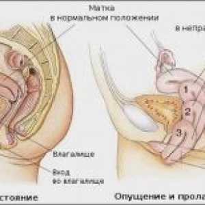 Malformații ale uterului: diagnostic si tratament