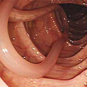 Consecințele și complicații ale viermilor intestinali la om