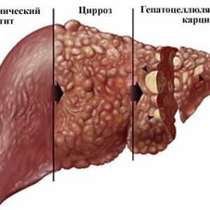 Consecințe opisthorchiasis la adulți, impactul asupra organismului uman