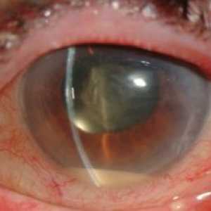 Ochii endoftalmită Postoperator
