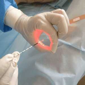 Cauterizare cu laser ulcer gastric ca metodă de tratament