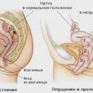 Prolapsul uterului si vaginului: tratament, simptome, o intervenție chirurgicală