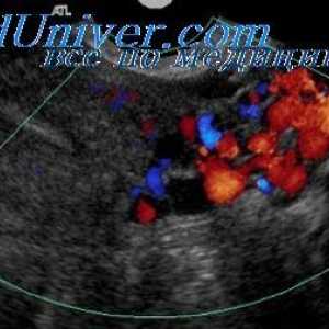 Prelungita forme de aspirina la femeile gravide. Doppler color