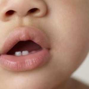 Dentiție la sugari (copii, sugari): simptome, semne