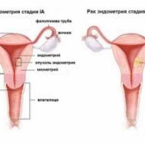 Cancer endometrial: simptome, etapa, tratament, diagnostic, prognostic, cauze, simptome, prevenirea