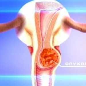 Cancerul de col uterin, simptome, stadiu, tratament, simptome, cauze, prognosticul