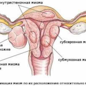Cancer uterin: stadiu, simptome, tratament, diagnostic