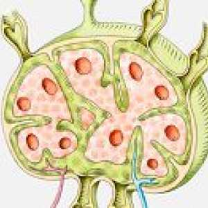 Cancerul a ganglionilor limfatici si stomac: diagnostic și tratament