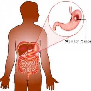 Cancerul de stomac: patogeneza, histologie, cât timp