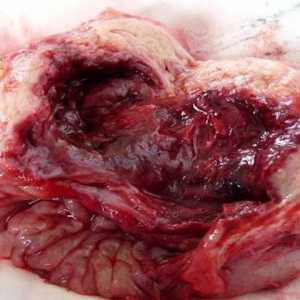 Ruptura chistului pancreasului și a altor complicații