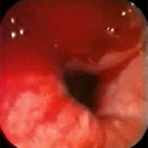 Ruptură a esofagului: Cauze, simptome, tratament