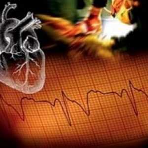 Resuscitarea în cardiologie la adulți