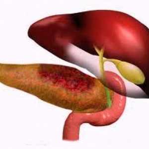 Pancreatită recurentă, forma acută sau cronică recurentă