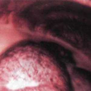 Indicații rare pentru intervenții toracoscopice asupra unor structuri anatomice ale mediastinului