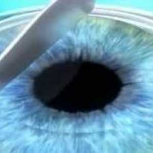 Chirurgia refractiva Ochi: Ce este?